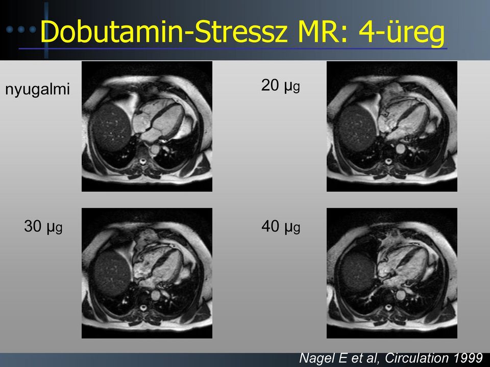 Dobutamin-Stressz MR: