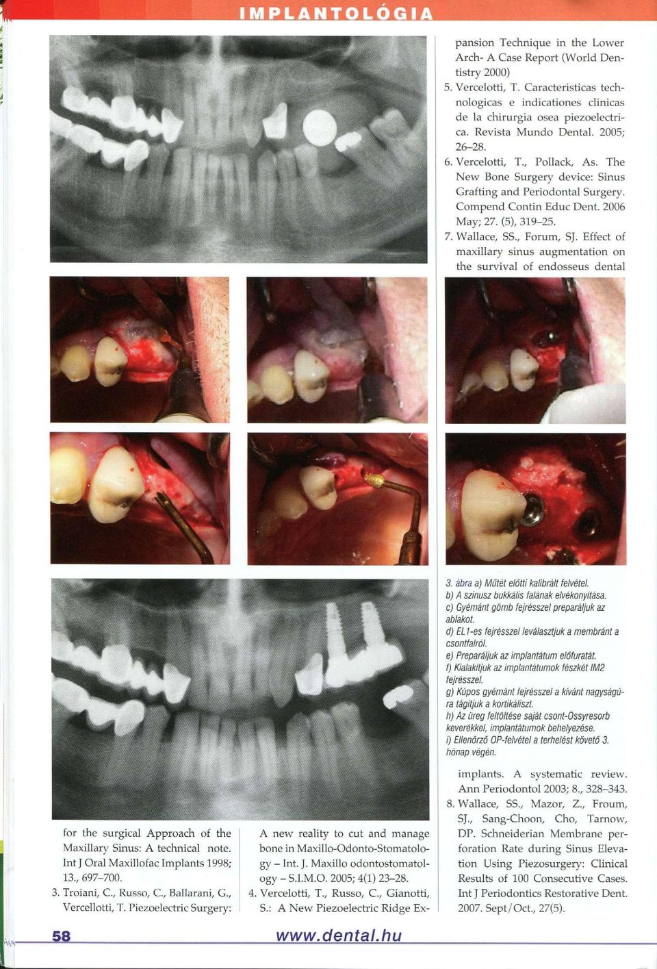 , Forum, SJ. Effect of maxillary sinus augmentation on the survival of endosseus dental for the surgical Approach of the Maxillary Sinus: A technical note. Int J Oral Maxillofac Implants 1998; 13.