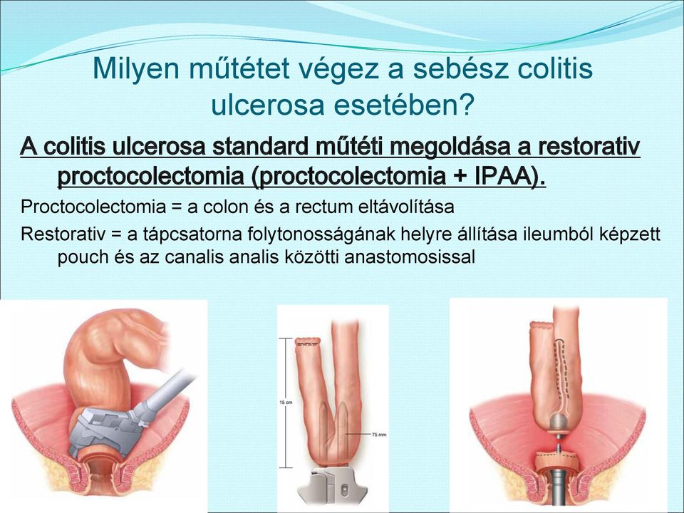 (proctocolectomia + IPAA).