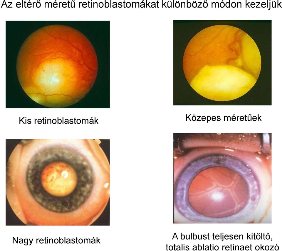 retinoblastomák Közepes méretűek Nagy