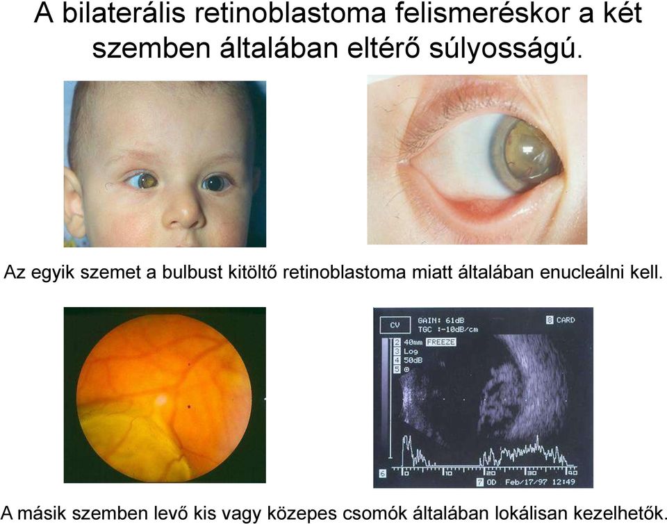 Az egyik szemet a bulbust kitöltő retinoblastoma miatt