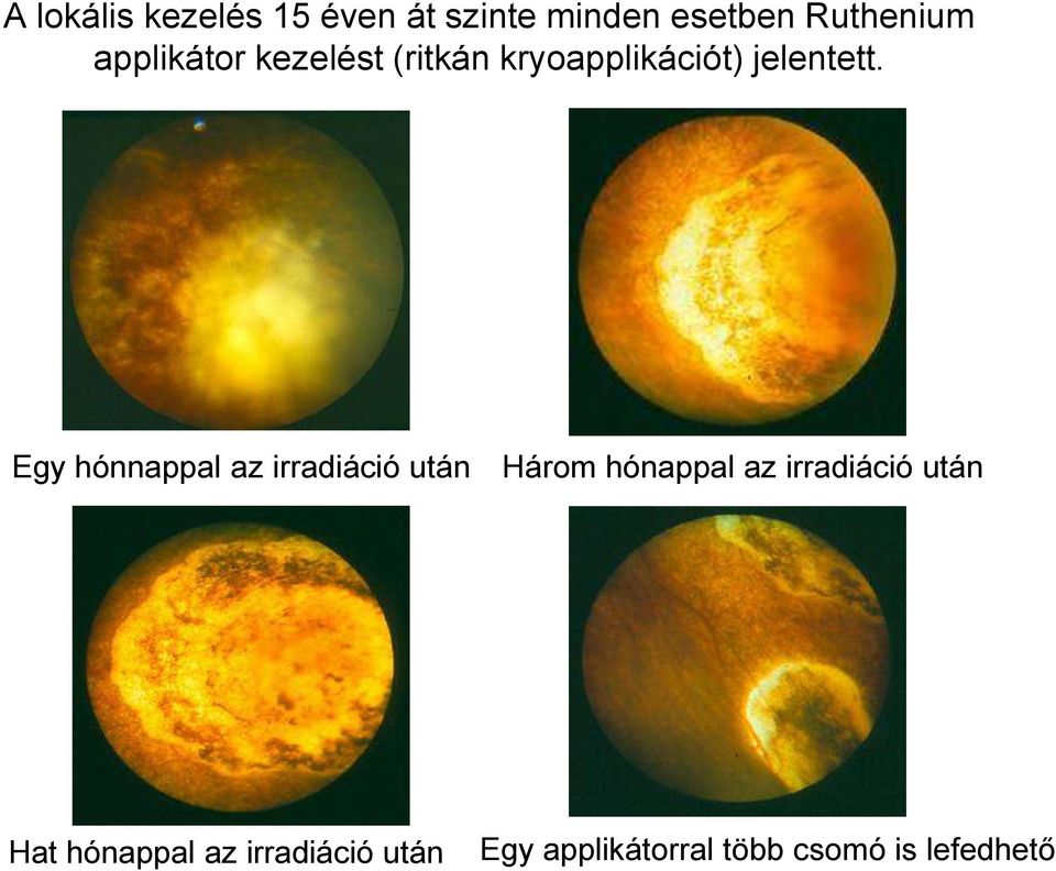 Egy hónnappal az irradiáció után Három hónappal az irradiáció