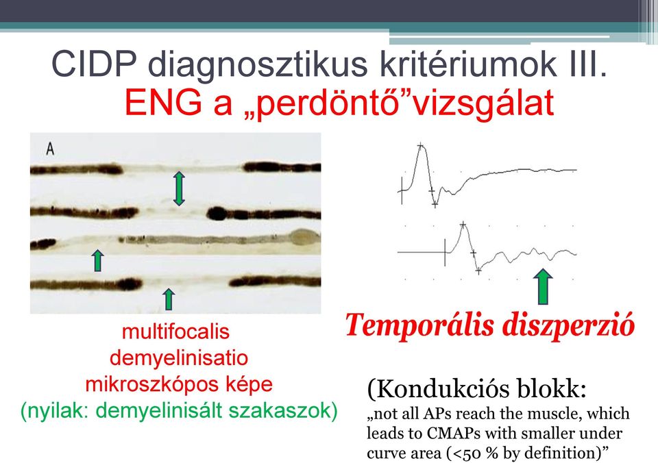 képe (nyilak: demyelinisált szakaszok) (Kondukciós blokk: not all