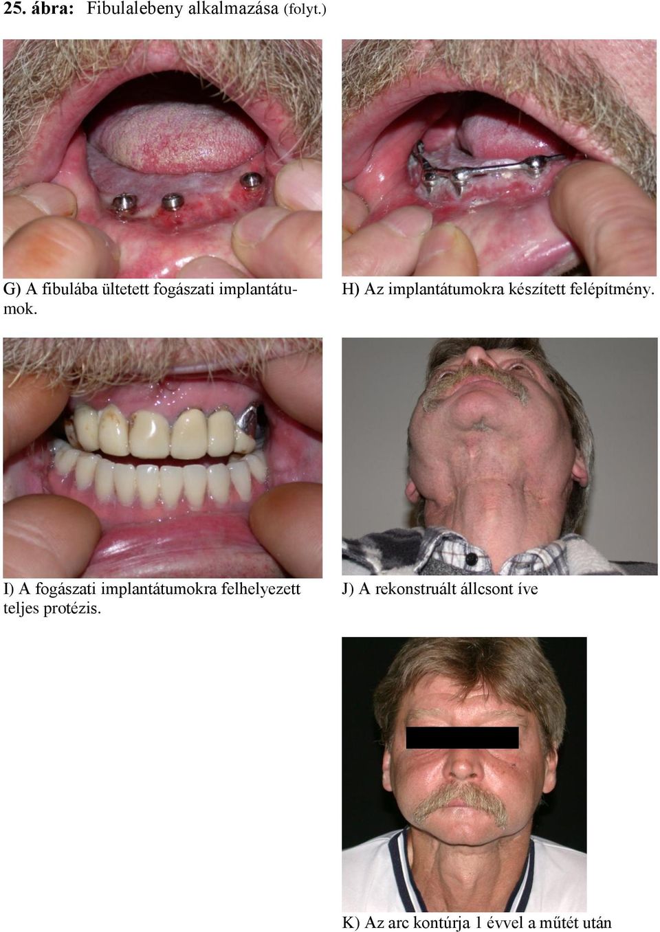 H) Az implantátumokra készített felépítmény.