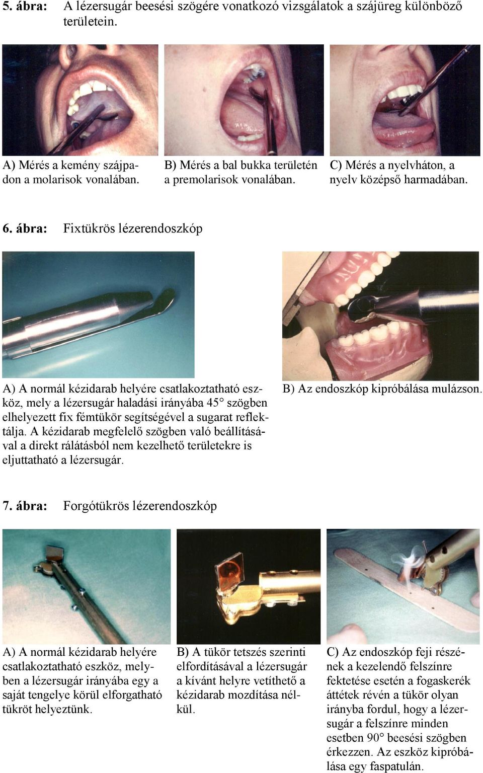ábra: Fixtükrös lézerendoszkóp A) A normál kézidarab helyére csatlakoztatható eszköz, mely a lézersugár haladási irányába 45 szögben elhelyezett fix fémtükör segítségével a sugarat reflektálja.