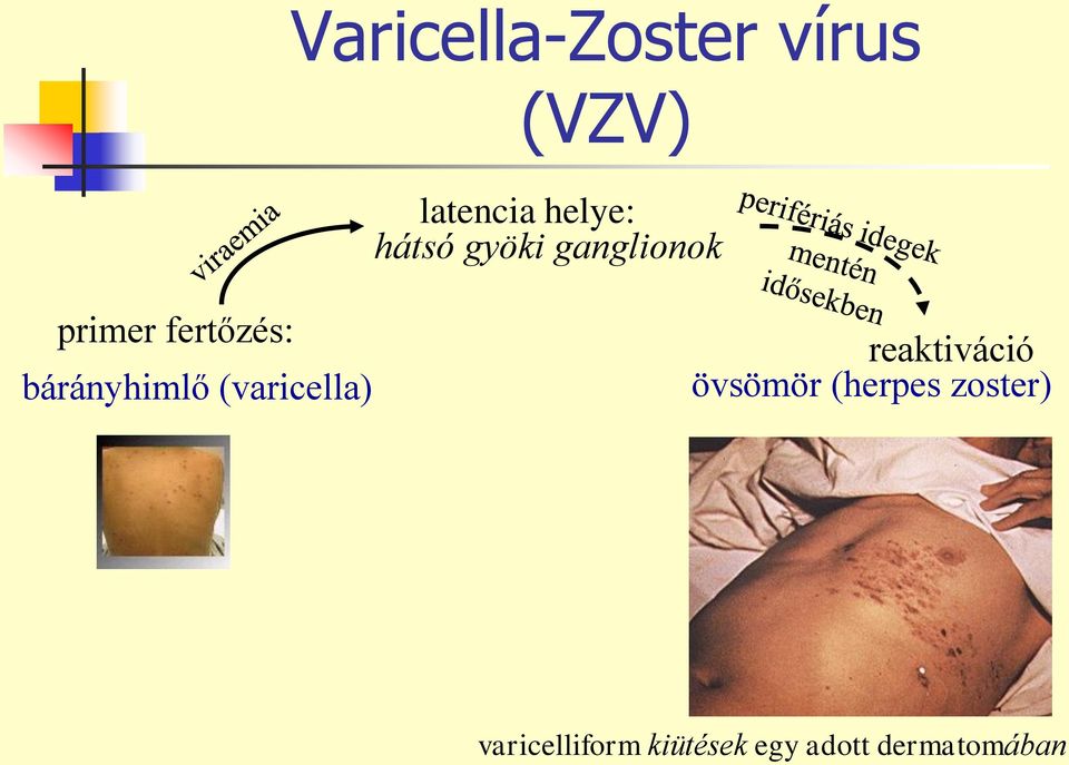 bárányhimlő (varicella) reaktiváció övsömör