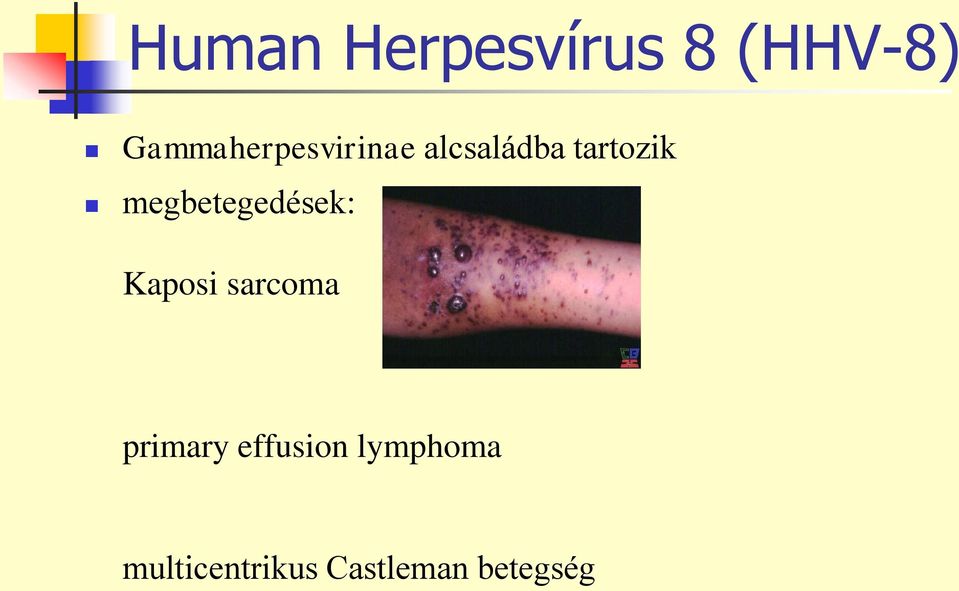 megbetegedések: Kaposi sarcoma primary