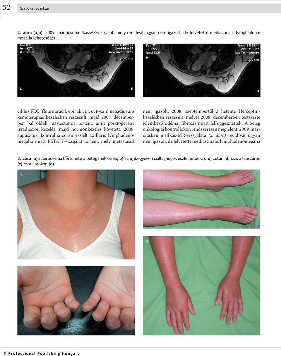 2008. ugusztusi kontrollj során észlelt xilláris lym ph de nomegli mitt PET/CT-vizsgált történt, mely metstsist nem igzolt. 2008. szeptemertől 3 hetente Herceptinkeze lés en részesült, melyet 2008.