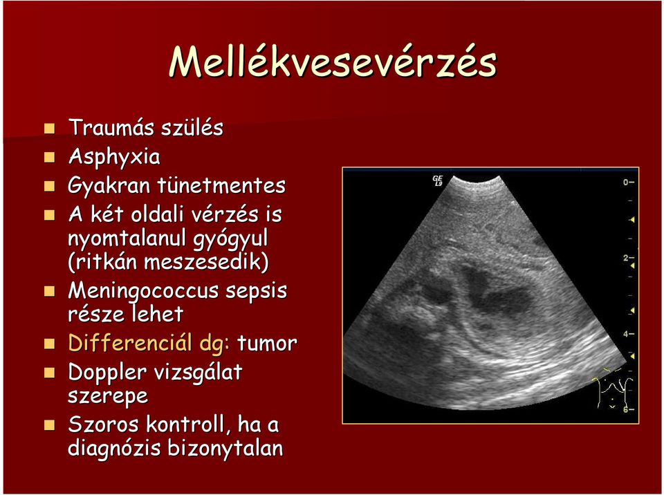 gyul (ritkán n meszesedik) Meningococcus sepsis része lehet