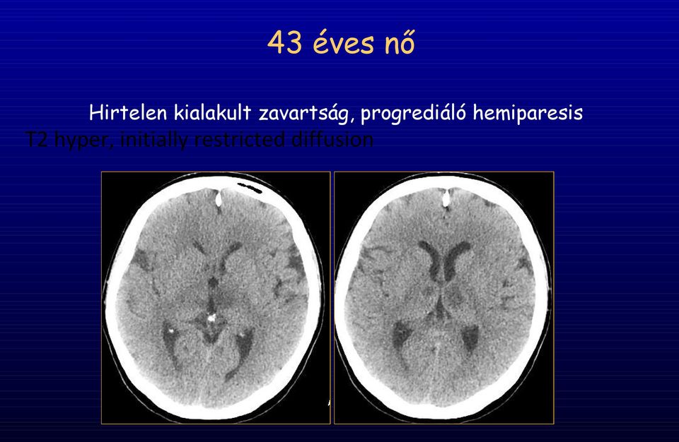 progrediáló hemiparesis T2