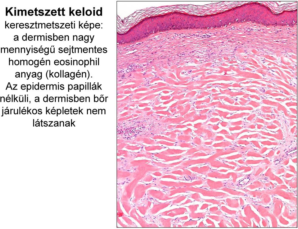 eosinophil anyag (kollagén).