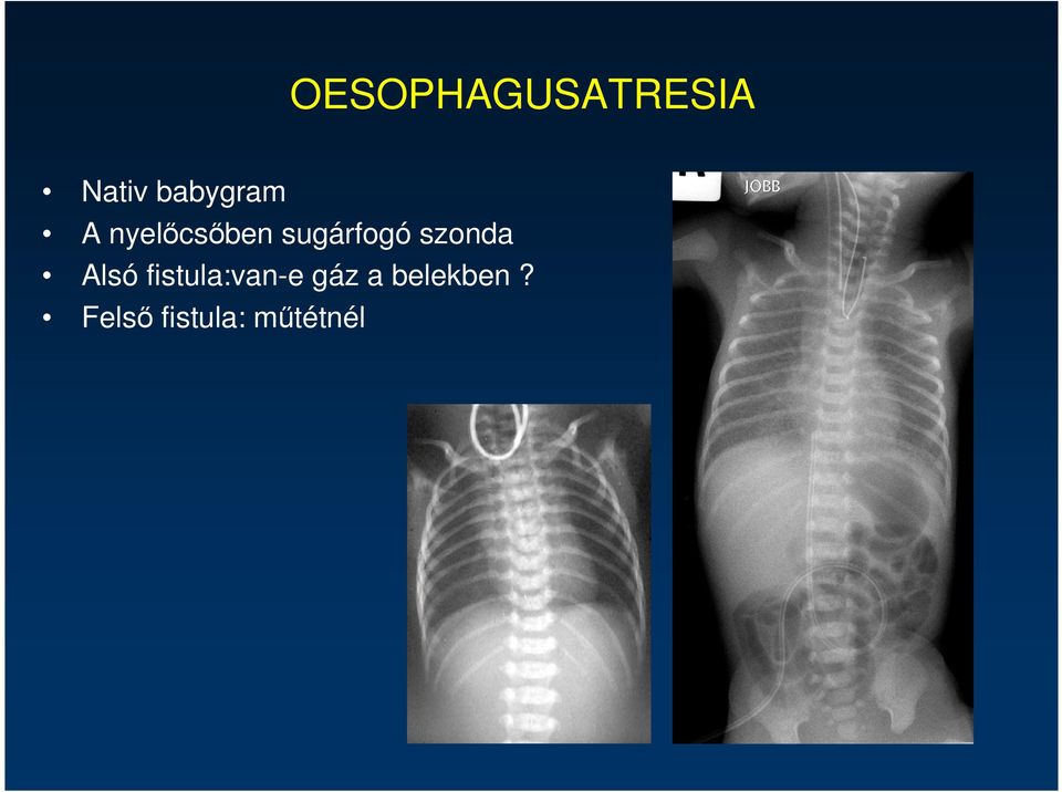 sugárfogó szonda Alsó