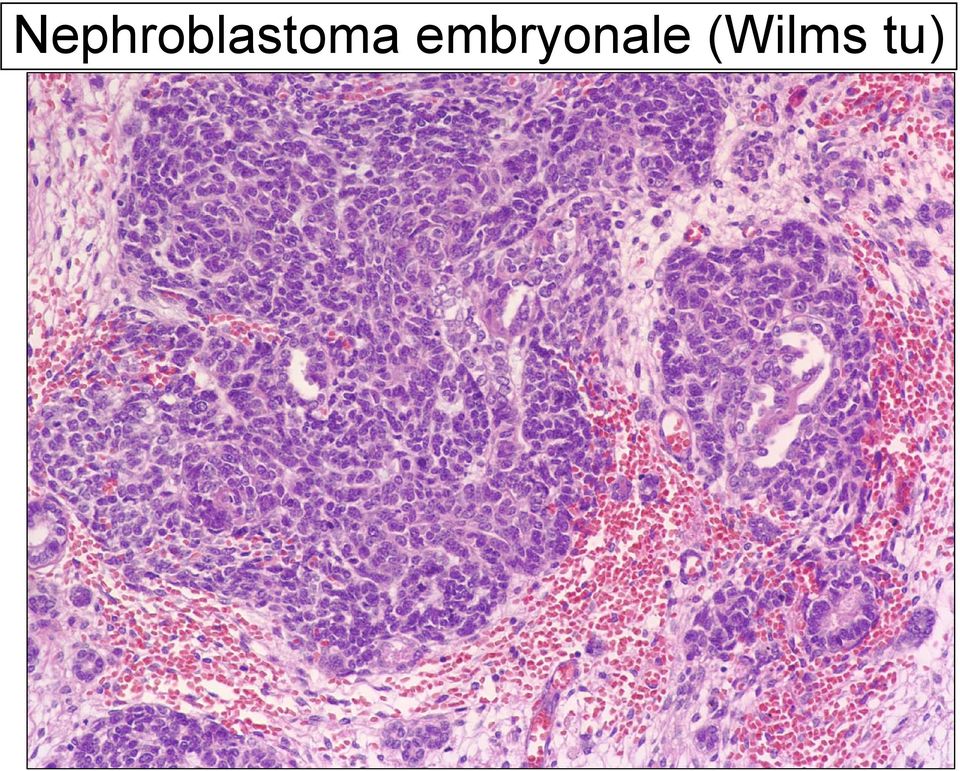 (nephroblastoma
