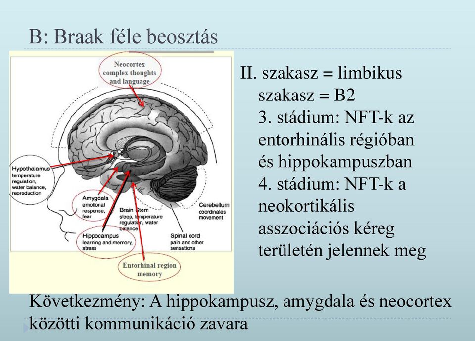 stádium: NFT-k a neokortikális asszociációs kéreg területén jelennek