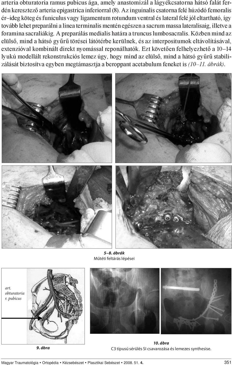 a sacrum massa lateralisaig, illetve a foramina sacraliákig. A preparálás medialis határa a truncus lumbosacralis.