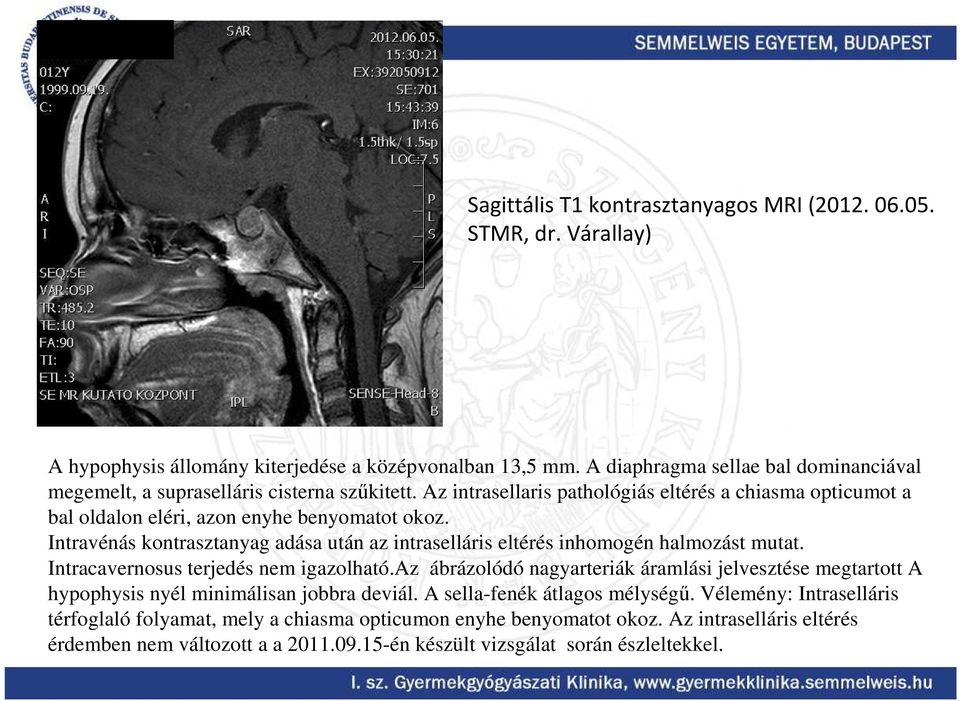 Intravénás kontrasztanyag adása után az intraselláris eltérés inhomogén halmozást mutat. Intracavernosus terjedés nem igazolható.