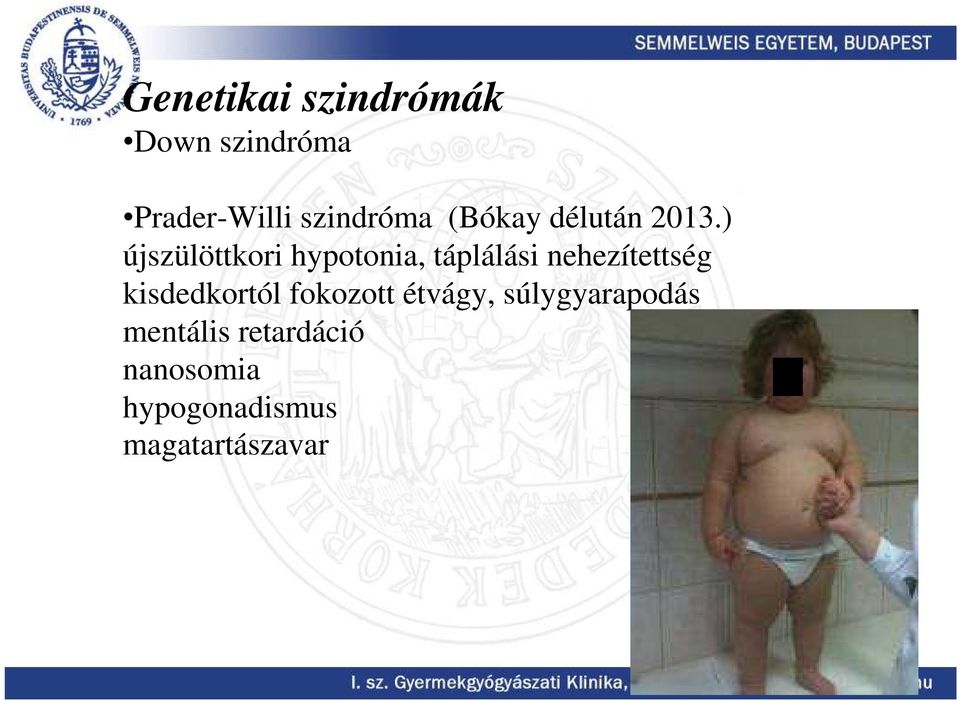 ) újszülöttkori hypotonia, táplálási nehezítettség