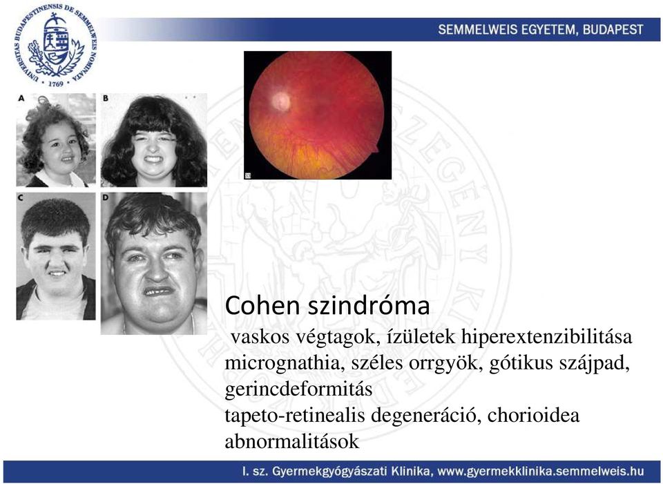 orrgyök, gótikus szájpad, gerincdeformitás