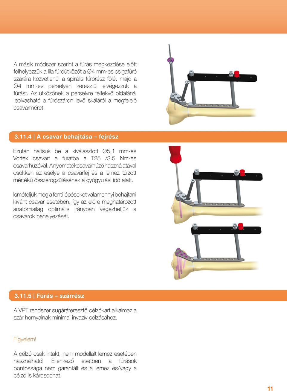 4 A csavar behajtása fejrész Ezután hajtsuk be a kiválasztott Ø5,1 mm-es Vortex csavart a furatba a T25 /3.5 Nm-es csavarhúzóval.