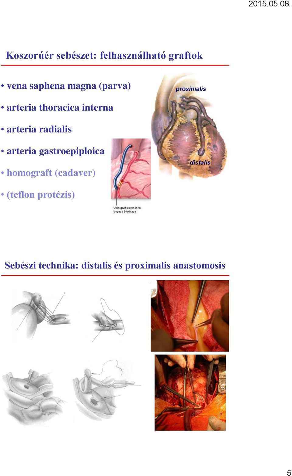 arteria gastroepiploica homograft (cadaver) distalis (teflon