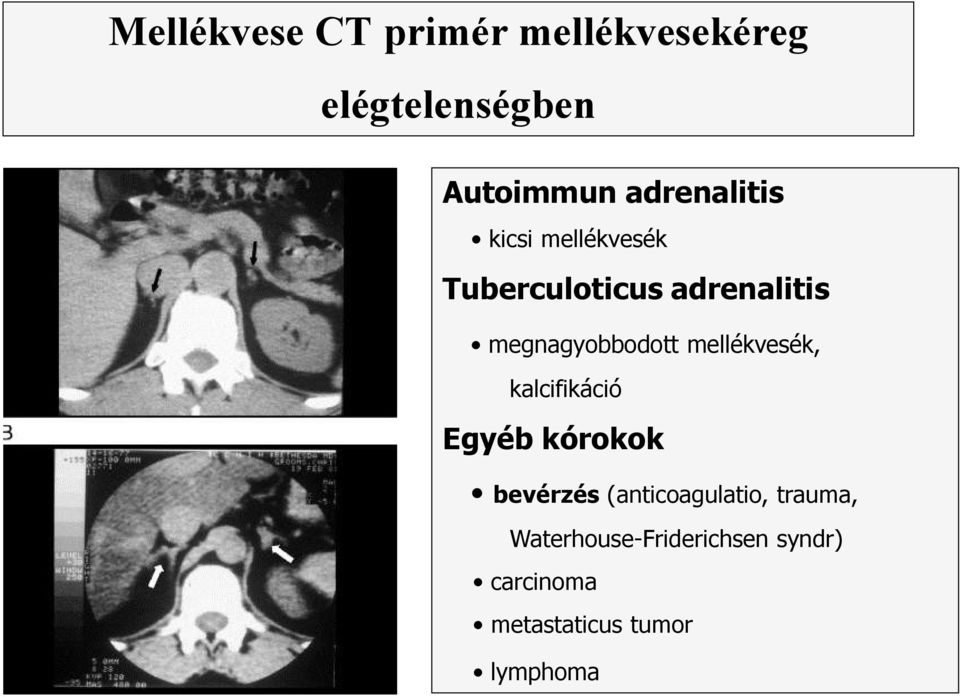 megnagyobbodott mellékvesék, kalcifikáció Egyéb kórokok bevérzés