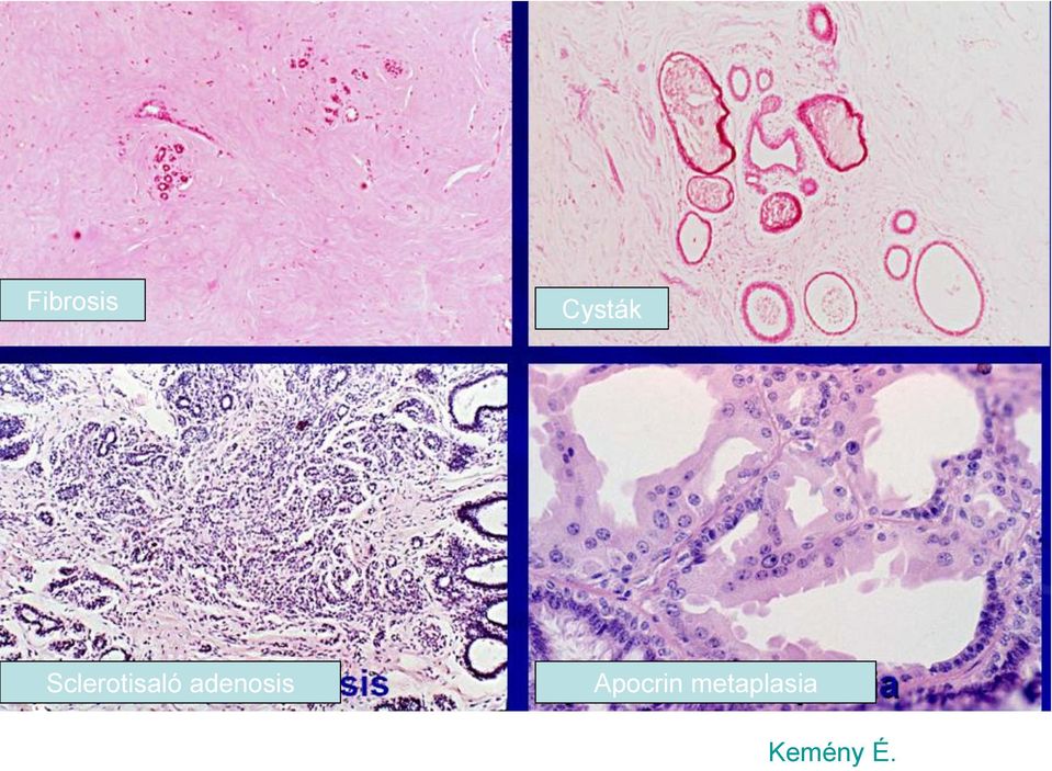 adenosis Apocrin