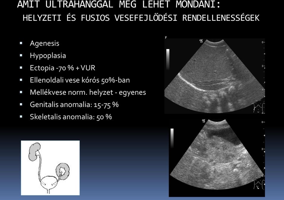 -70 % + VUR Ellenoldali vese kórós 50%-ban Mellékvese norm.