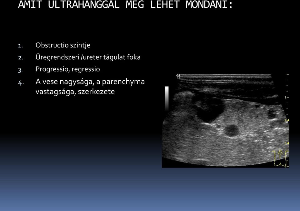 Üregrendszeri /ureter tágulat foka 3.