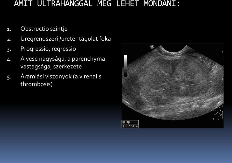 Üregrendszeri /ureter tágulat foka 3.