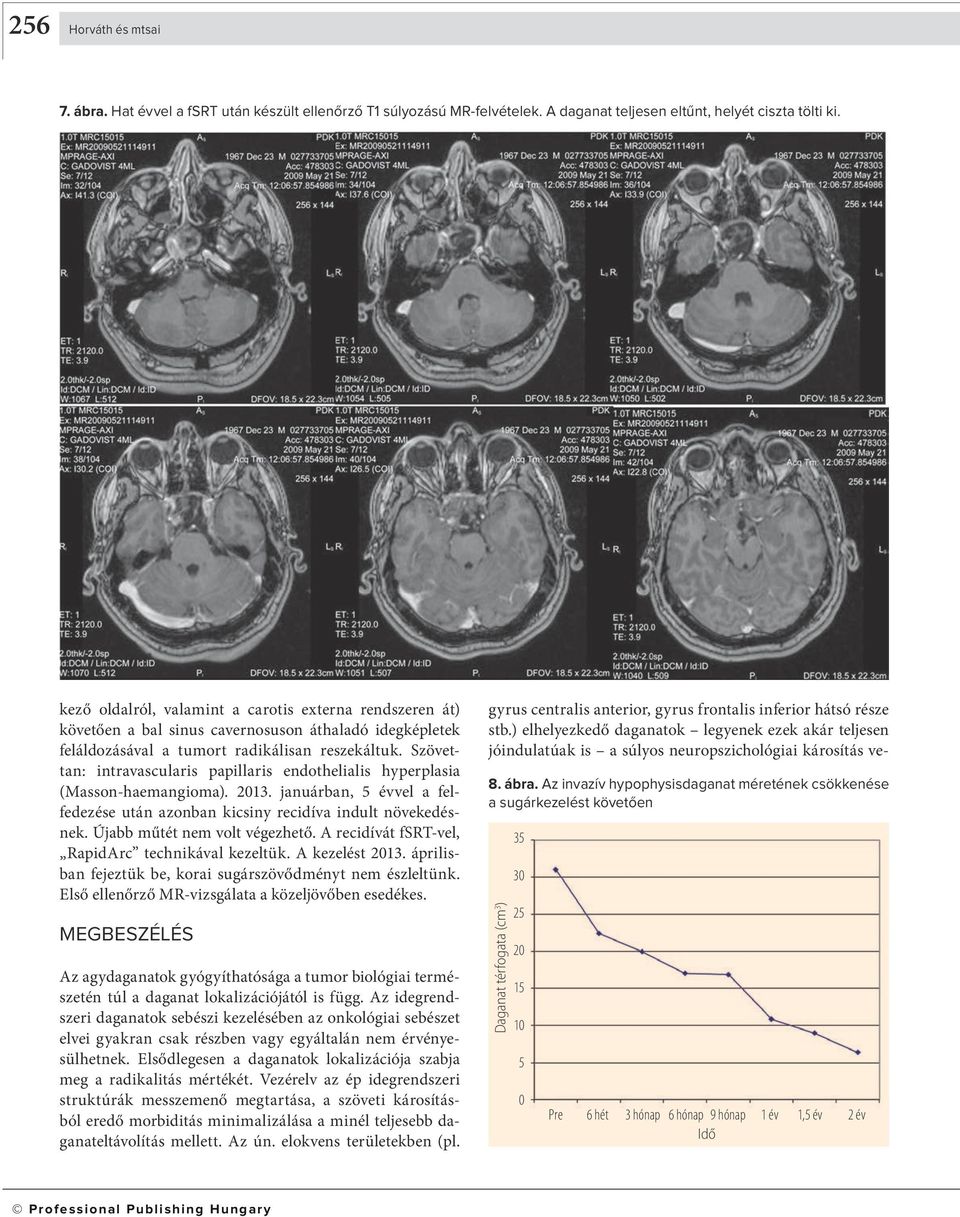 Szövettan: intravascularis papillaris endothelialis hyperplasia (Masson-haemangioma). 2013. januárban, 5 évvel a felfedezése után azonban kicsiny recidíva indult növekedésnek.