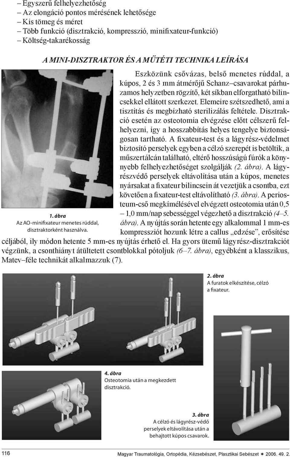 Eszközünk csővázas, belső menetes rúddal, a kúpos, 2 és 3 mm átmérőjű Schanz csavarokat párhuzamos helyzetben rögzítő, két síkban elforgatható bilincsekkel ellátott szerkezet.