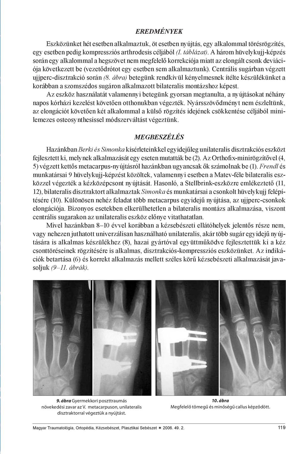 Centrális sugárban végzett ujjperc-disztrakció során (8. ábra) betegünk rendkívül kényelmesnek ítélte készülékünket a korábban a szomszédos sugáron alkalmazott bilateralis montázshoz képest.