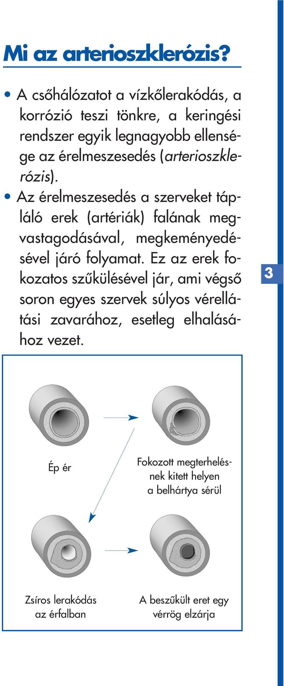 (arterioszklerózis). Az érelmeszesedés a szerveket tápláló erek (artériák) falának megvastagodásával, megkeményedésével járó folyamat.