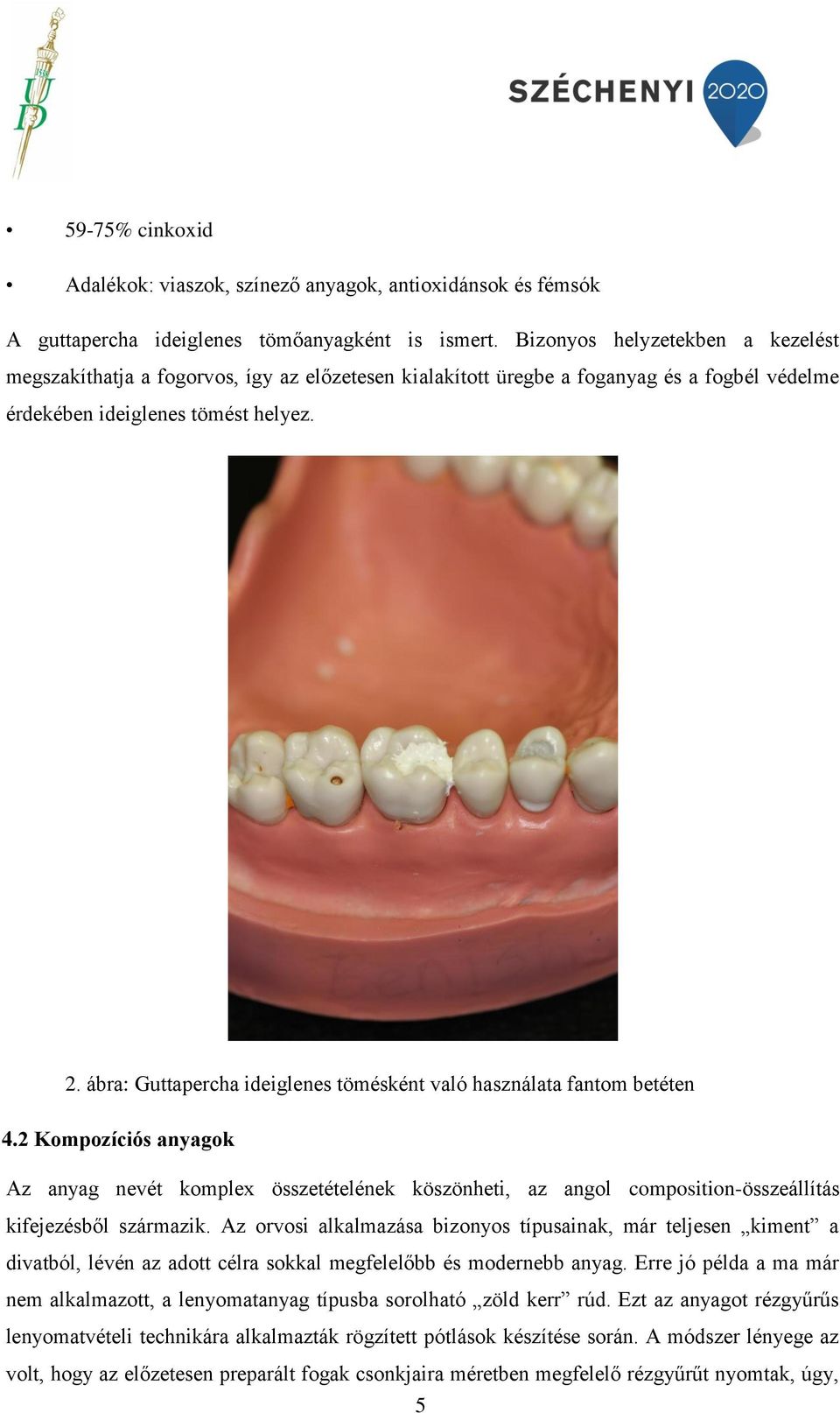 ábra: Guttapercha ideiglenes tömésként való használata fantom betéten 4.