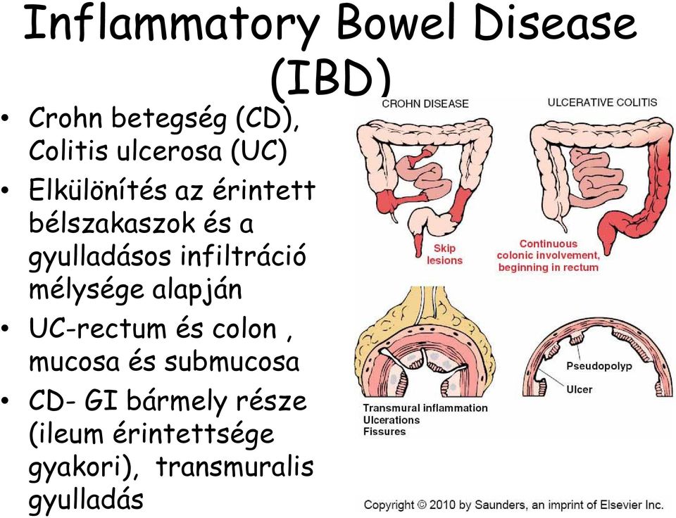 infiltráció mélysége alapján UC-rectum és colon, mucosa és