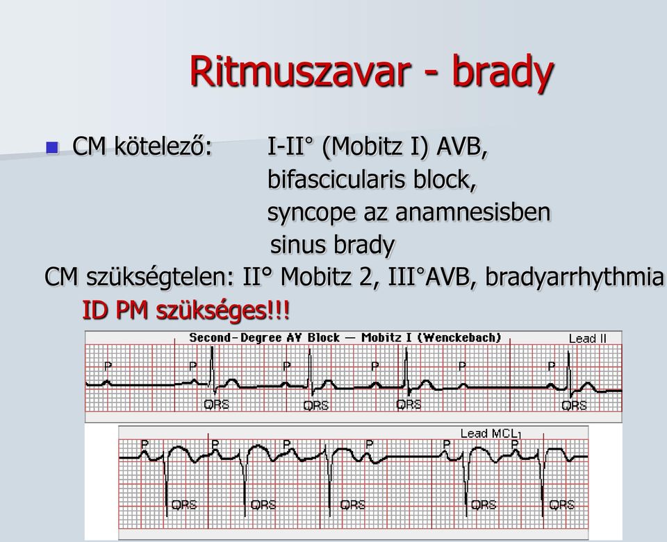 anamnesisben sinus brady CM szükségtelen: II