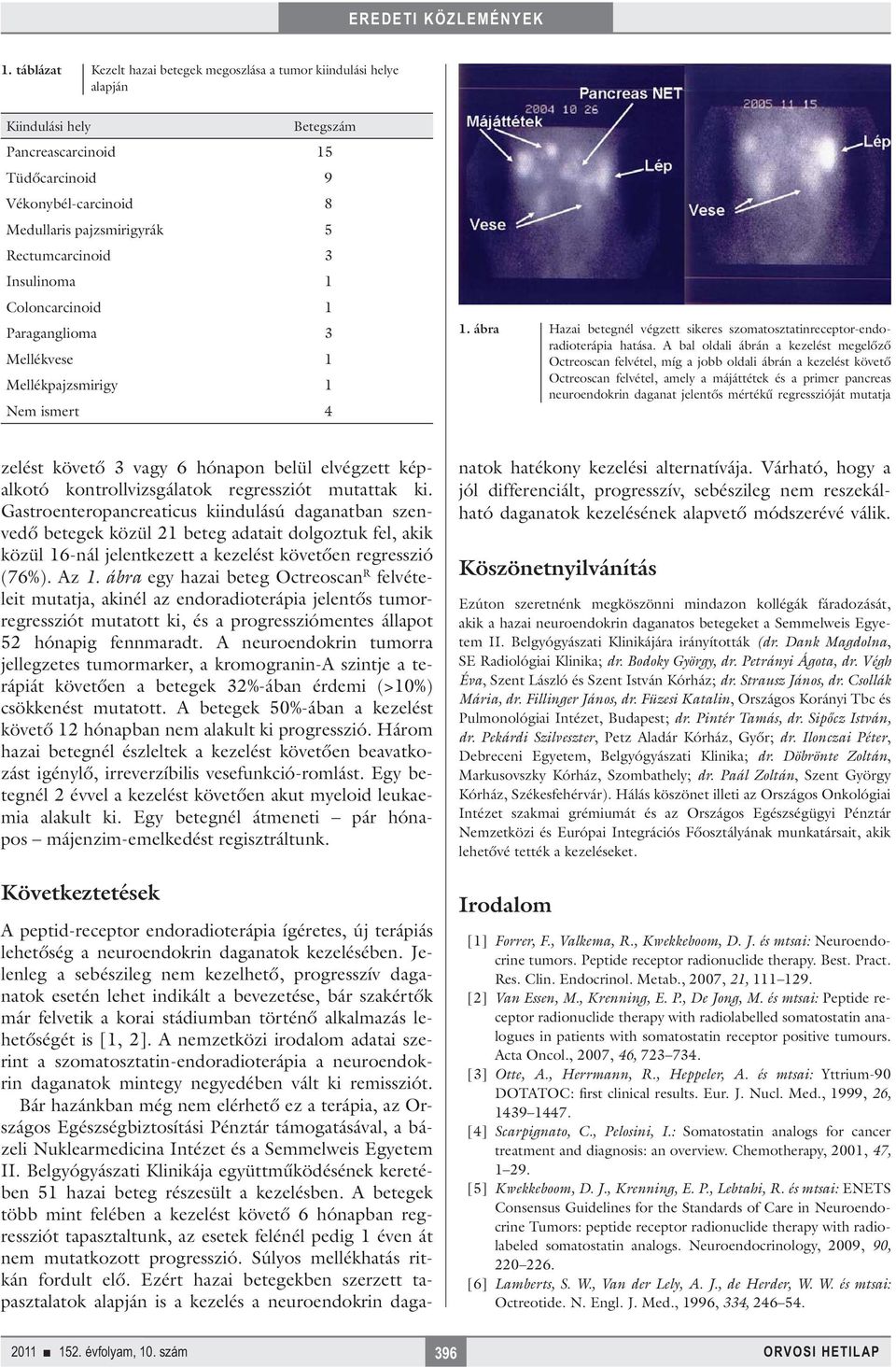 A bal oldali ábrán a kezelést megelőző Octreoscan felvétel, míg a jobb oldali ábrán a kezelést követő Octreoscan felvétel, amely a májáttétek és a primer pancreas neuroendokrin daganat jelentős