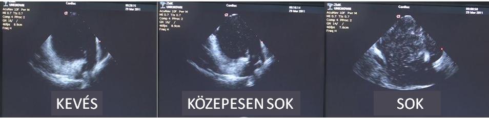 Intracardiális Echocardiográfia (ICE) A két single-shot technika összehasonlításának vizsgálatakor a beavatkozás során ICE segítségével monitoroztuk a bal pitvari buborékképződést.