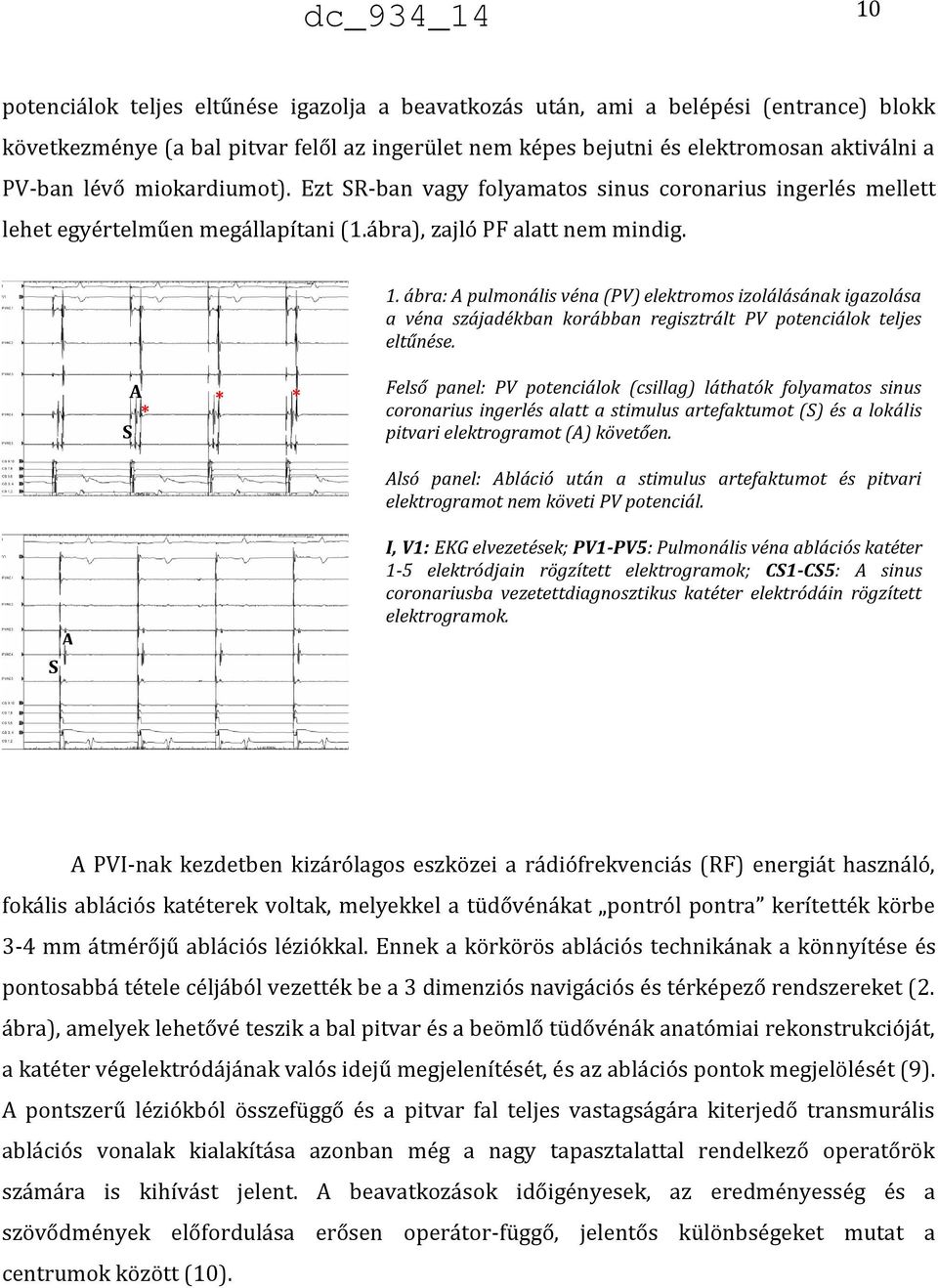 ábra: A pulmonális véna (PV) elektromos izolálásának igazolása a véna szájadékban korábban regisztrált PV potenciálok teljes eltűnése.
