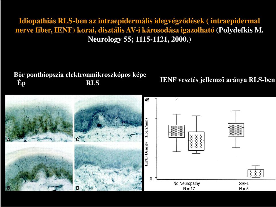 igazolható (Polydefkis M. Neurology 55; 1115-1121, 2000.