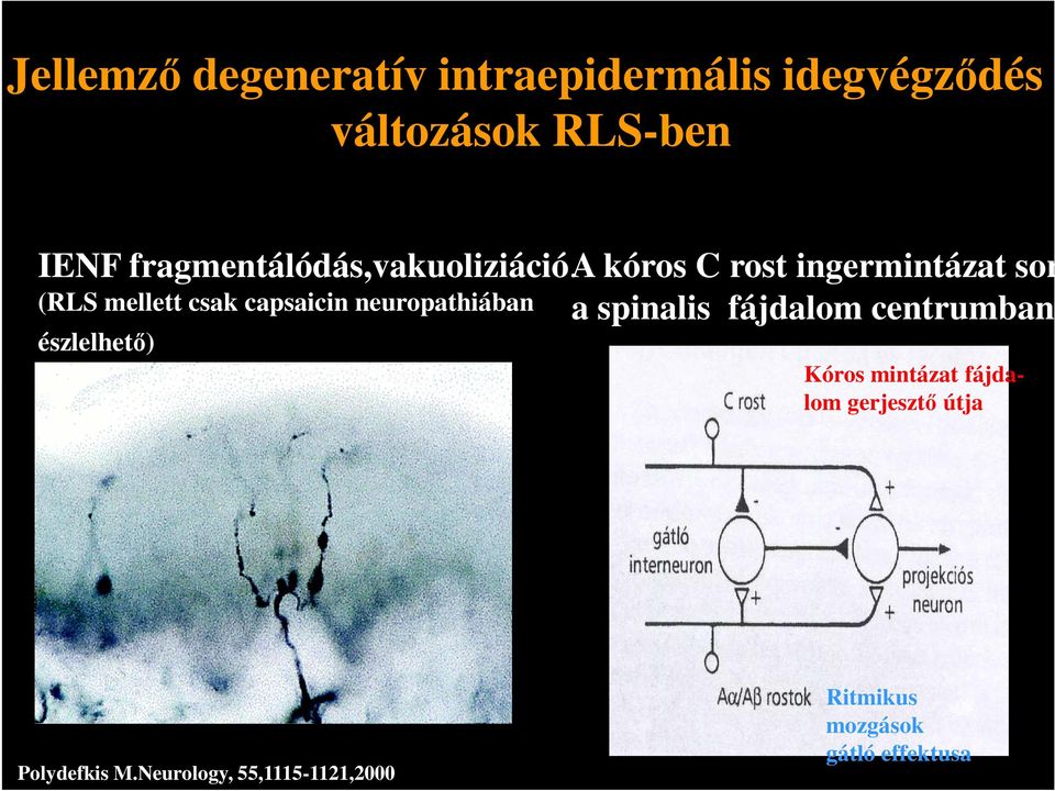A kóros C rost ingermintázat sorsa (RLS mellett csak capsaicin neuropathiában a