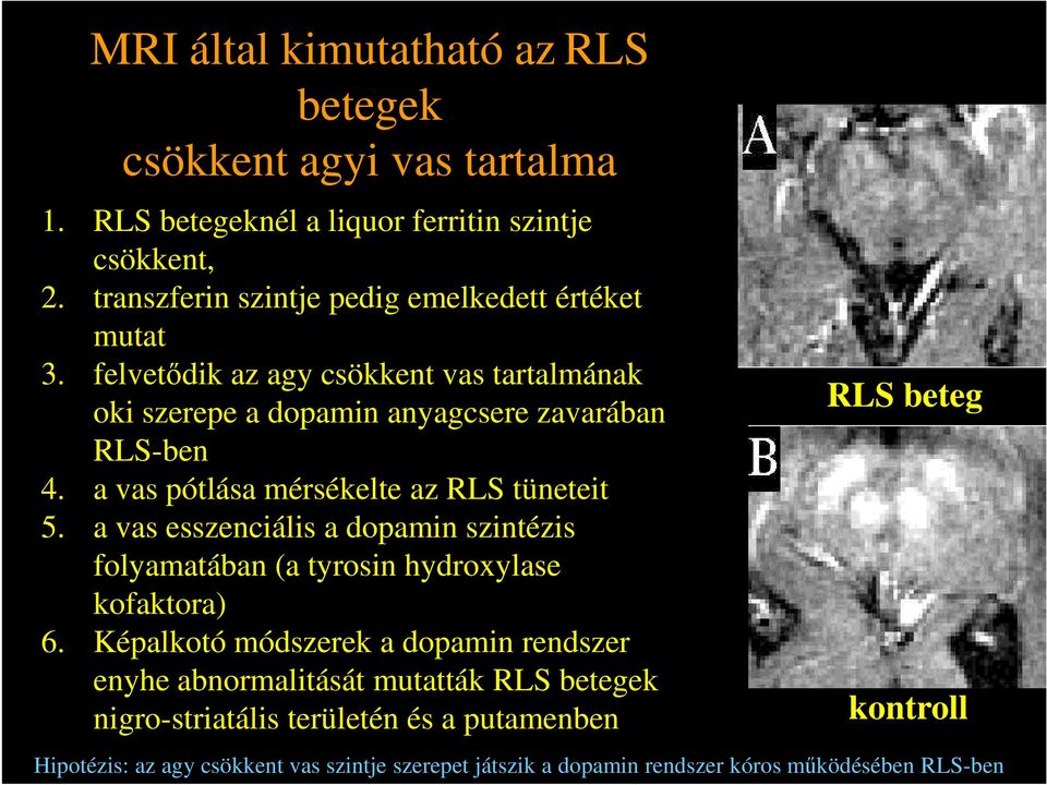 a vas pótlása mérsékelte az RLS tüneteit 5. a vas esszenciális a dopamin szintézis folyamatában (a tyrosin hydroxylase kofaktora) 6.