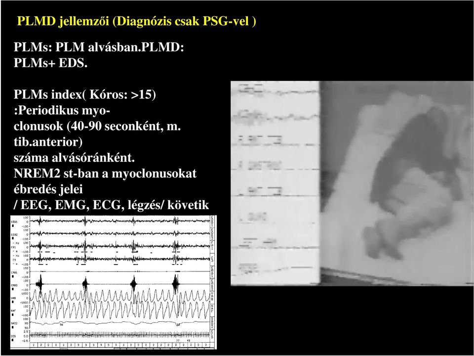 PLMs index( Kóros: >15) :Periodikus myoclonusok (40-90