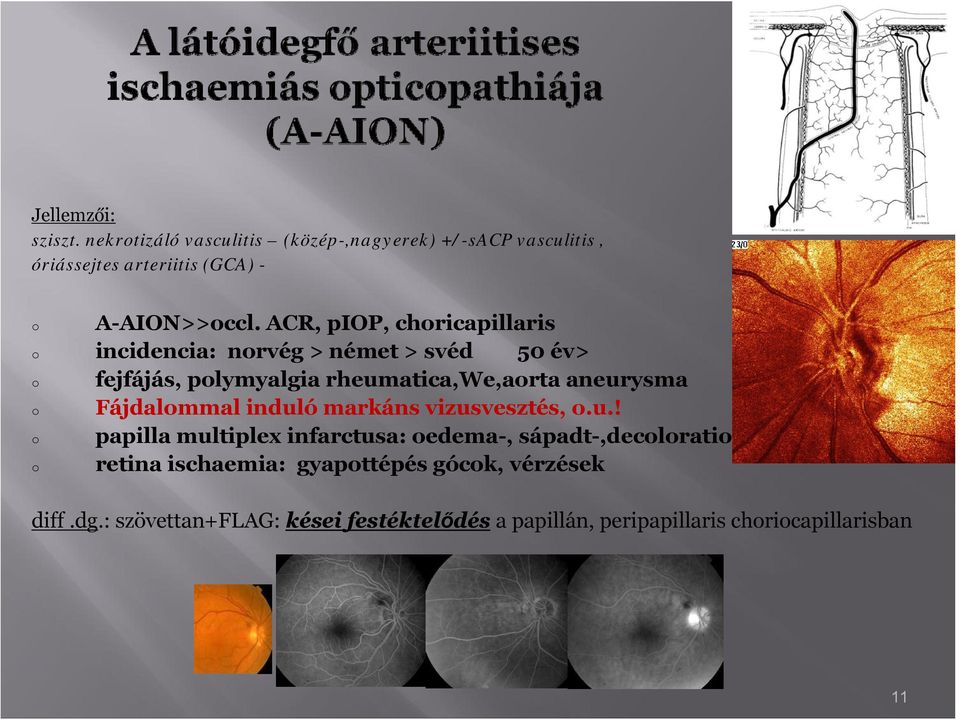 ACR, piop, chricapillaris incidencia: nrvég > német > svéd 50 év> fejfájás, plymyalgia rheumatica,we,arta aneurysma