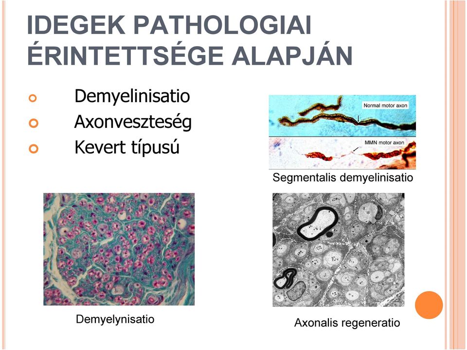 Kevert típusú Segmentalis