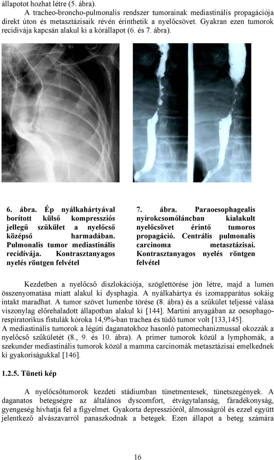 Pulmonalis tumor mediastinális recidívája. Kontrasztanyagos nyelés röntgen felvétel 7. ábra. Paraoesophagealis nyirokcsomóláncban kialakult nyelőcsövet érintő tumoros propagáció.