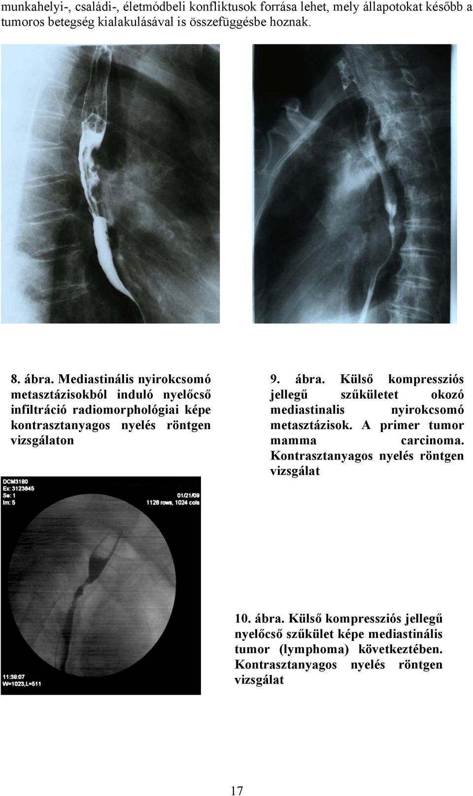 Külső kompressziós jellegű szűkületet okozó mediastinalis nyirokcsomó metasztázisok. A primer tumor mamma carcinoma.