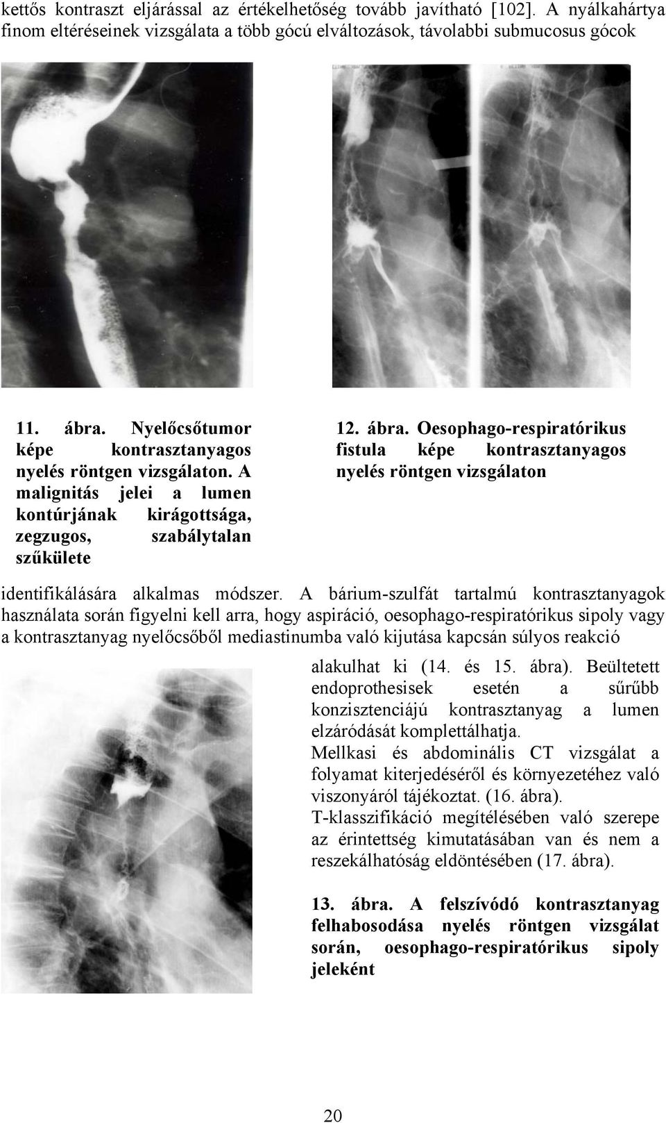 Oesophago-respiratórikus fistula képe kontrasztanyagos nyelés röntgen vizsgálaton identifikálására alkalmas módszer.