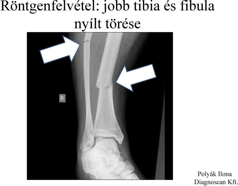 fibula nyílt törése