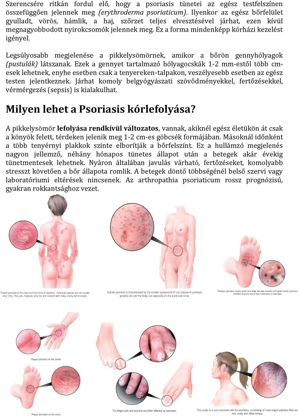 psoriasis jelentese)